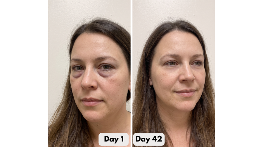 Under-Eye Red Light Therapy