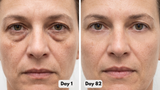 Under-Eye Red Light Therapy