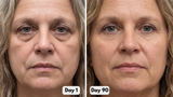 Under-Eye Red Light Therapy