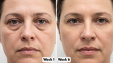 Under-Eye Red Light Therapy