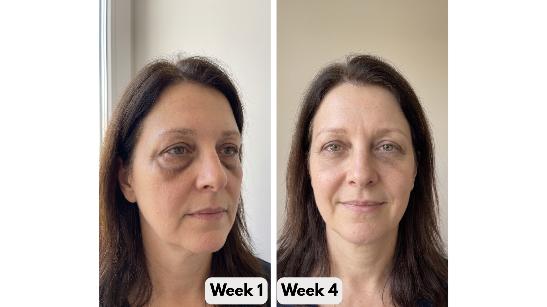 Under-Eye Red Light Therapy
