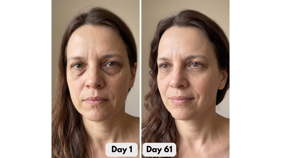Under-Eye Red Light Therapy